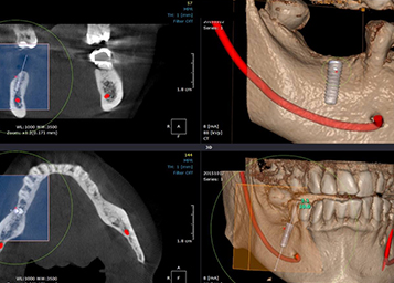 Dental Cone- Beam Bilgisayarlı Tomografi